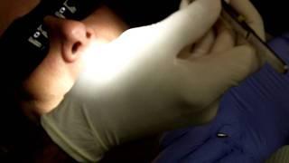 Safe-Vac HVE Dental Instruments Aid During Implant Procedure