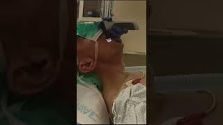 Medical Intubation Fixed Flexed Neck is a non issue when using the VS with the paraglossal technique