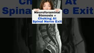 What Does My MRI Mean? L4 L5 Disc Bulge | #short | Dr. Walter Salubro Chiropractor In Vaughan