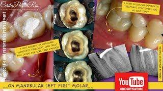bypass instrument root canal - perawatan gigi berlubang saluran akar dokter gigi konservasi