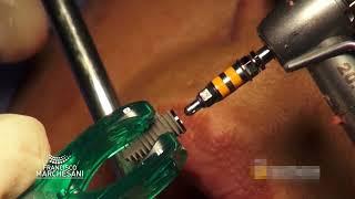 INSTALACIÓN DE IMPLANTE EN REBORDE PREVIAMENTE RECONSTRUIDO MEDIANTE BOXTECHNIQUE MAXILAR INFERIOR