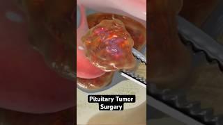 Pituitary Tumor Surgery (3D Animation)