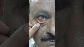 Eye disease #youtubeshorts #optometry #hospital