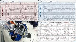 Exploring Brain Activity in Microgravity with g.HIamp: Airbus A380 Zero-G Flight