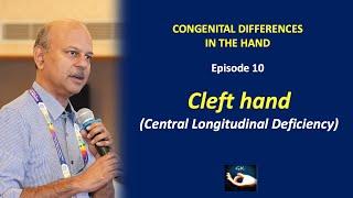 Congenital hand: Episode 10 - Cleft hand - Presentation, classification and management