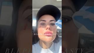#upperblepharopasty #faceland #uppereyelidsurgery #surgery #faceliftingsurgery #botoxbrowlift