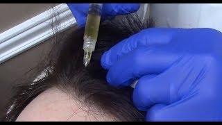 PRP Therapy for Hair Loss | Utah Valley Dermatology