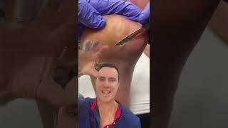 / docpods #callus corn and callus removal explained by australian podiatrist #corn #callus #podiatri