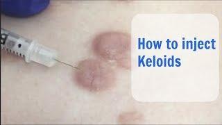 Keloid Injection - Cosmetic Institute of Australia