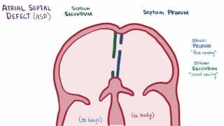 Atrial septal defect ASD repair, causes, types, symptoms & pathology