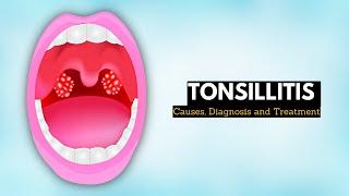 Tonsillitis, Causes, Signs and Symptoms, Diagnosis and Treatment.