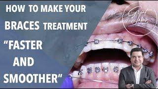 How to Make Your Dental Braces Treatment Faster and Painless | Damon Braces | Pain Free Fast Braces