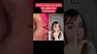 Seringomas !! Cada nome esquisito em dermatologia!!!