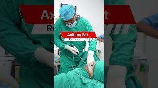 Axillary Fat Removal #short #shorts #Shortvideo #AxillaryFatRemoval #AxillaryFat #Axillary #Fat