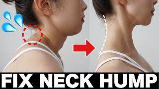 Quick 8-minute fix for Neck Hump