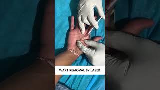 Warts Removal With Laser Treatment | Safe and Effective Wart Removal Treatment | Skinaa Clinic#viral