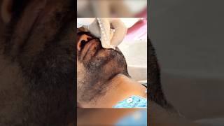White Beard Removal Treatment By Fue Method | White Beard Permanent Solution | #whitebeard #fue