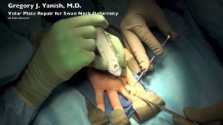 Volar Plate Repair for Swan Neck Deformity