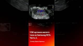 Вторая часть УЗИ малого таза на Samsung W10 - смотрите на канале @medliga #short #shorts #medical