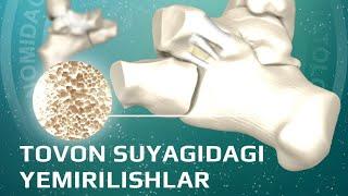 Tovon suyagidagi yemirilishlar +998954007076