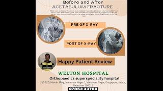 Patient review |  Acetabulum fracture surgery recovery | Welton Hospital | Best Orthopaedic Hospital