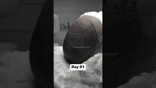4 Months After DMC Golden Touch Hair Transplant | Dadu Medical Centre