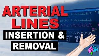 Insertion & Removal of Arterial Lines!