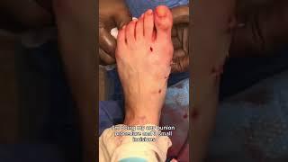 How to Fix Bunions in 30 Seconds