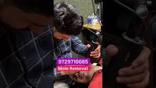 Mole Removal with Co2 Laser | Mole Treatment #shorts #viral #trending #skincare #drshahidmirza