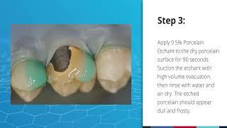 Repair of PFM or Zirconia/Alumina Restorations