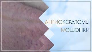  Ангиокератомы мошонки. Клинический случай №43