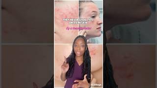 They Never show this skin problem on dark skin tones!!