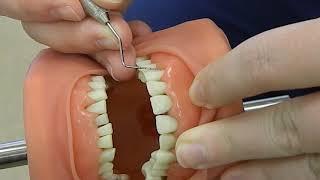 Periodontal Probe Technique