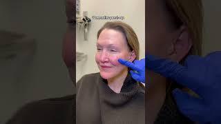 Facelift recovery #nycfacelift #faceliftsurgeon #faceliftexpert #faceliftbeforeandafter #faceliftnyc