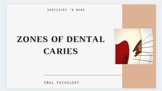 DENTAL CARIES ZONES