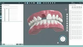 Extraction Tool | 3D Dental Imaging Software