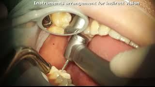 Instruments placement for dental indirect vision