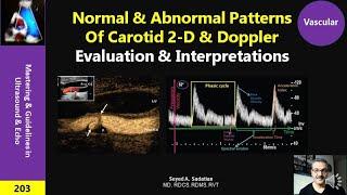 Normal & Abnormal Patterns of Carotid Doppler