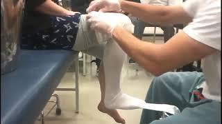 Applying a patella tendon bearing (PTB) cast