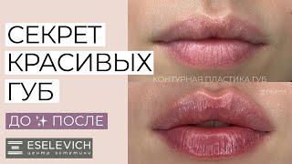 Увеличение Губ или Контурная Пластика Препаратом Juvederm. Результат До и После.