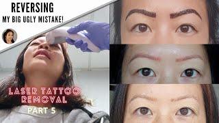 3rd Microblading Removal session: Putting the 532 laser to test-Part 5