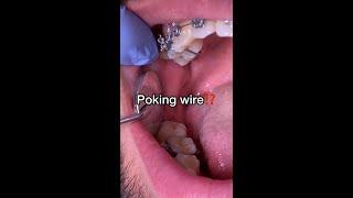 What to do if you have a Poking Wire - Braces Emergency - Tooth Time Family Dentistry New Braunfels