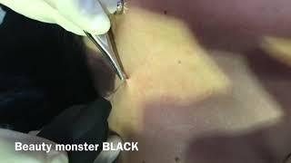 Beauty Monster Black (with Plasma tip) - Pigmentation, Blemish