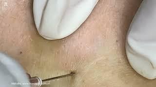 Big Cystic Acne Blackheads Extraction Blackheads & Milia, Whiteheads Removal Pimple Popping