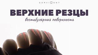 Морфология верхних резцов | CARVIDENT