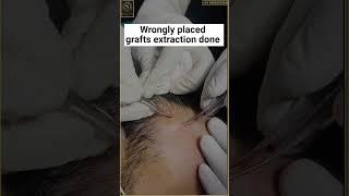 Repair Hair Transplant | Hairline Fixing | Hair Transplant Correction | Best Hair transplant Clinic