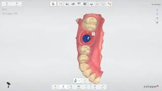 3Shape TRIOS- Implant restoration workflow IT