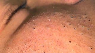Anua Korean Skincare Routine (For Clear, Acne-Free Skin)