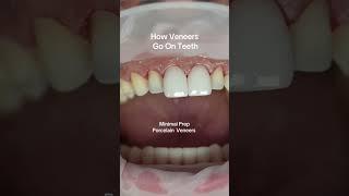 How veneers go on teeth