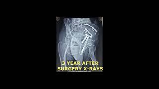 Best results after complex acetabulum surgery in 85 yr old male #weltonhospital #hospital #jaipur